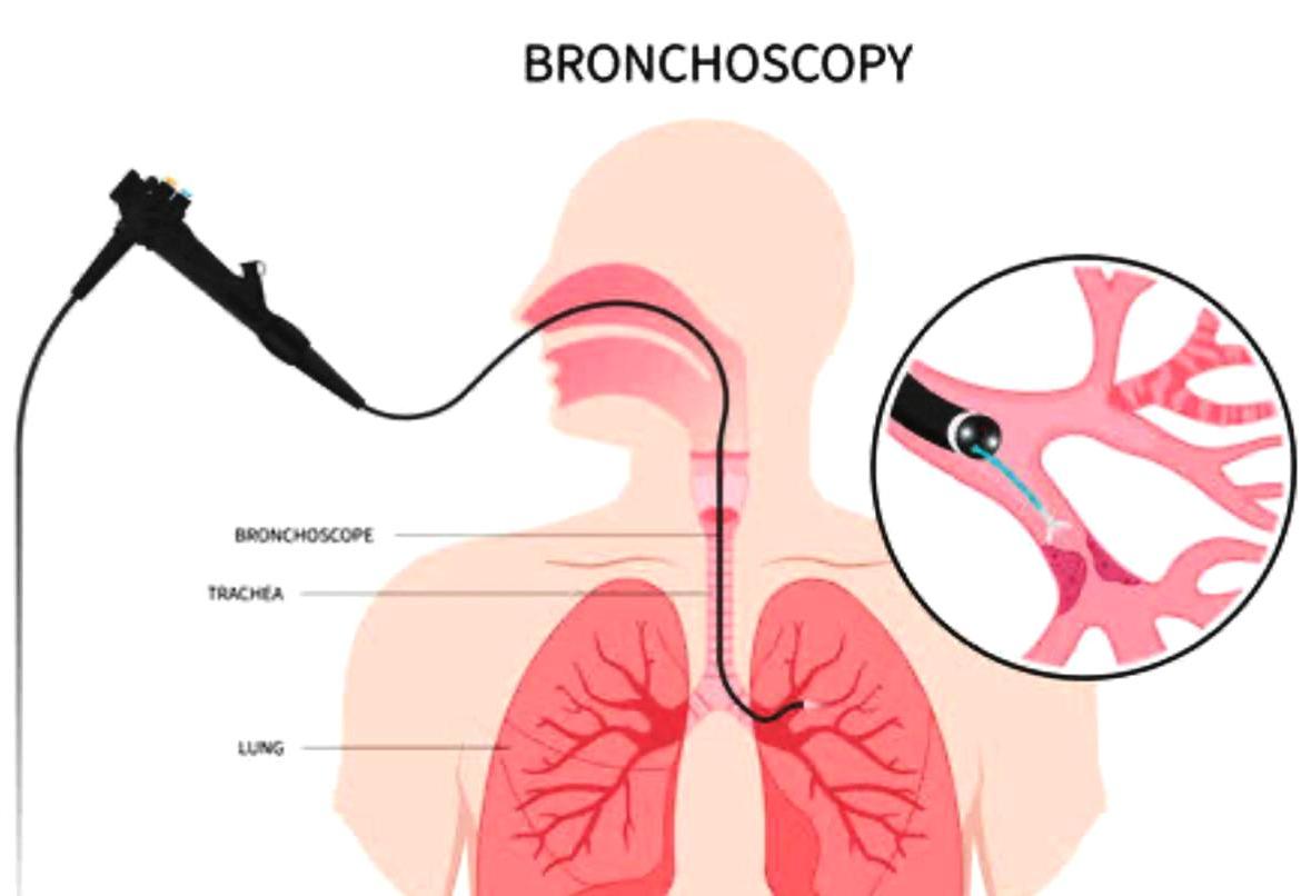 Diagnostic & Therapeutic Bronchoscopy & Thoracoscopy